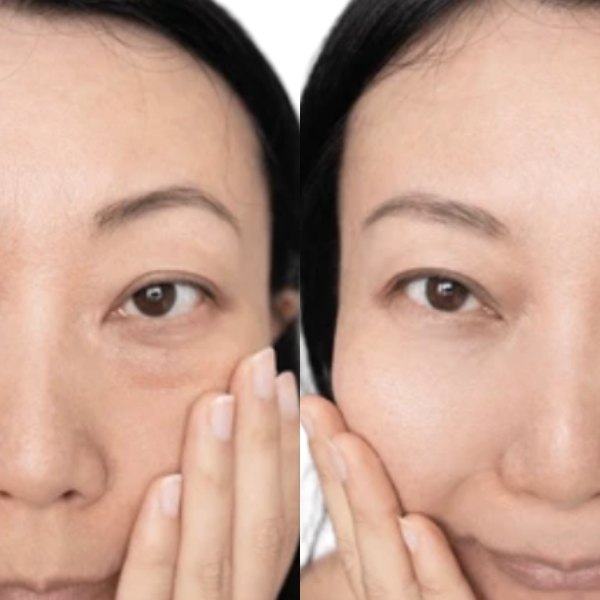 Eyebag Treatment treatment result